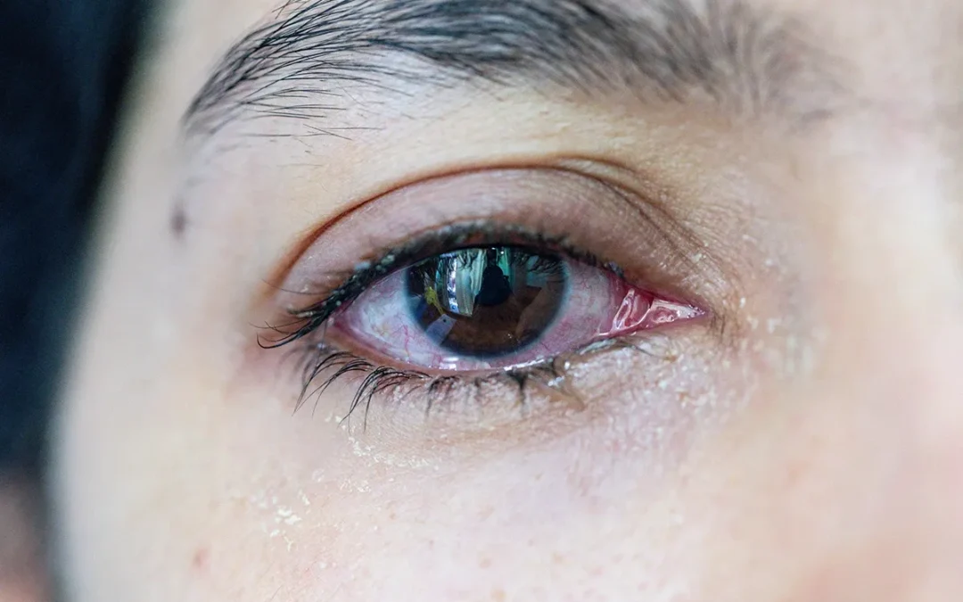 Watery Eyes? What Your Eyes May Be Trying to Tell You